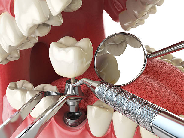 Best Same-Day Emergency Dentist in Kahoka, MO